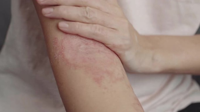 女人涂皮炎霜涂抹药物真菌感染受伤