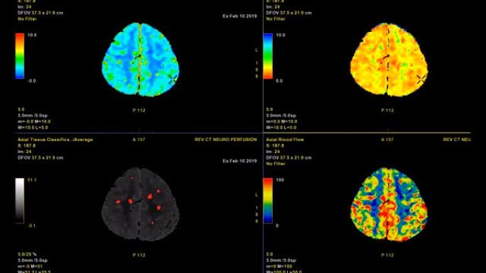 CT脑灌注或ct扫描图像的大脑3d渲染图像分析脑血流在监视器上。