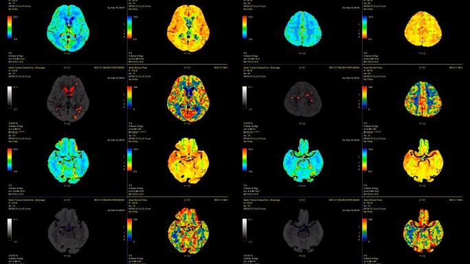 CT脑灌注或ct扫描图像的大脑3d渲染图像分析脑血流在监视器上。