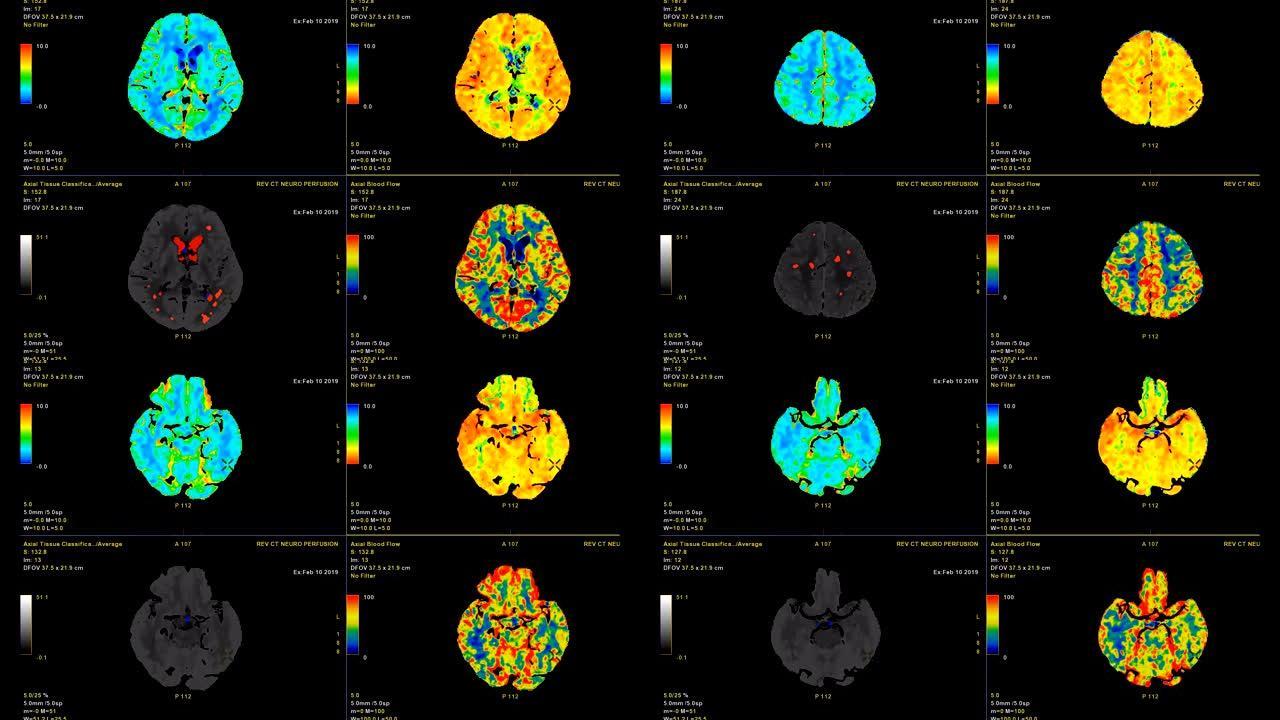 CT脑灌注或ct扫描图像的大脑3d渲染图像分析脑血流在监视器上。