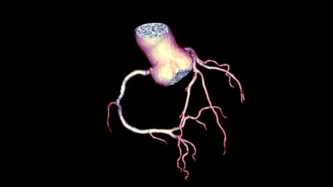 CTA冠状动脉3D渲染图像或冠状动脉树在屏幕上翻转以诊断血管冠状动脉狭窄。