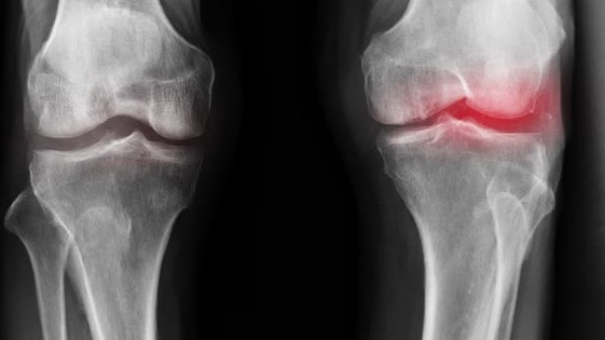 带有近距离膝关节和红色高光的OA膝盖x射线图像素材