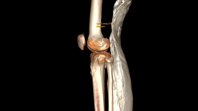 CT膝关节3D渲染图像，长腿板显示胫骨骨折。