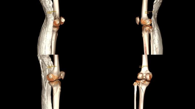 CT膝关节3D渲染图像，长腿板显示胫骨骨折。