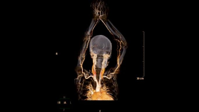 肱动脉CTA或上肢ct扫描三维渲染图像诊断肱动脉狭窄。