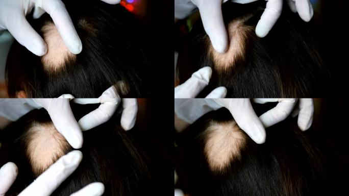 女人脱发。医生或美容师做检查，做程序，女人的头。