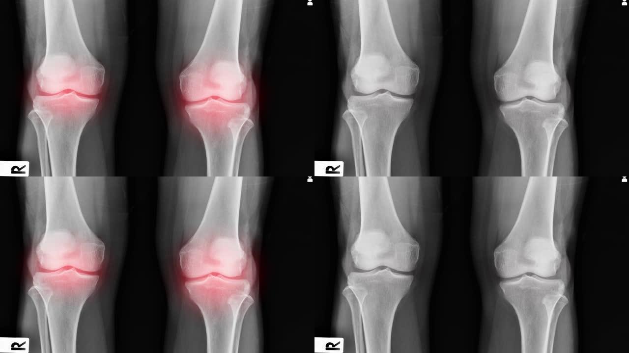 OA膝关节x线图像