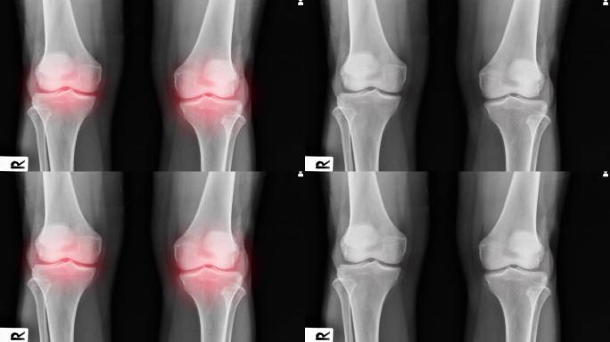 OA膝关节x线图像