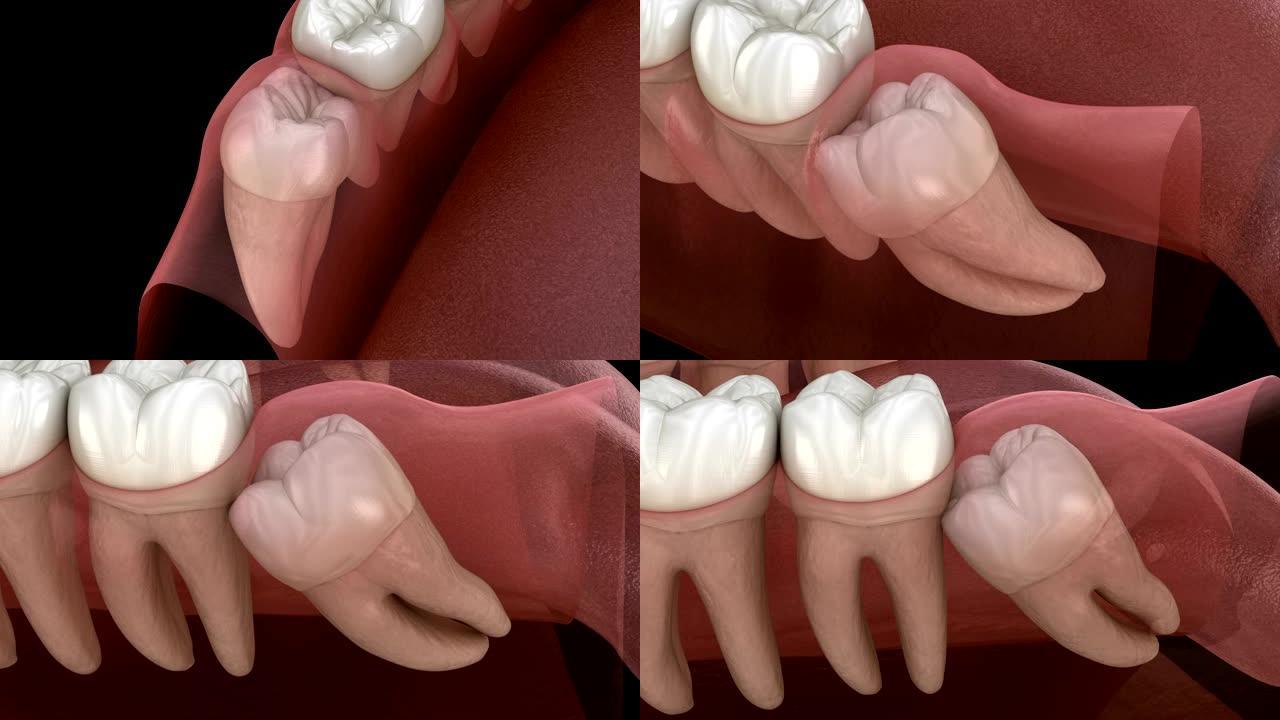 健康牙齿和智齿，中间嵌塞。医学上精确的牙齿3D动画