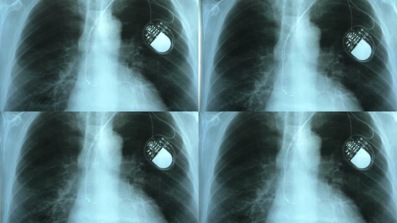 医生检查胸部x光图像植入人工心脏起搏器