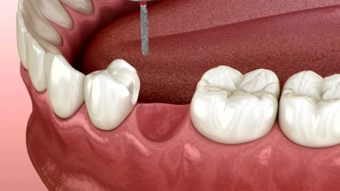 马里兰桥由陶瓷制成，前牙恢复。医学上精确的牙科概念3D动画