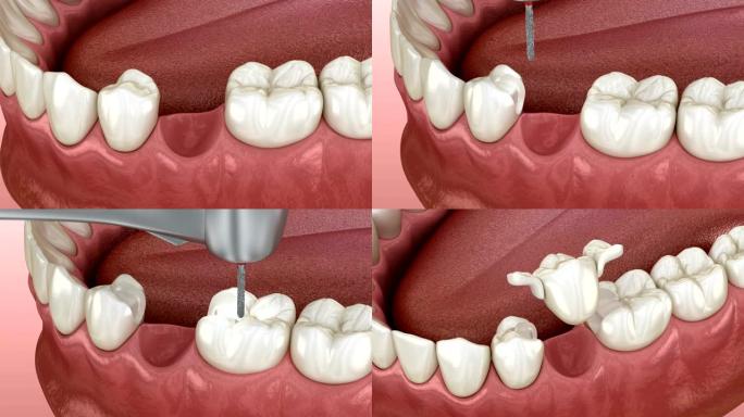 马里兰桥由陶瓷制成，前牙恢复。医学上精确的牙科概念3D动画