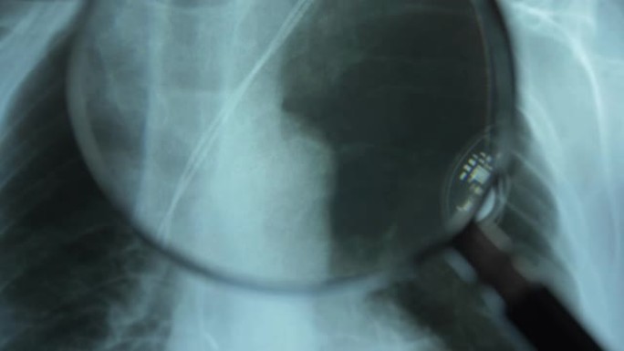 放大镜下人工心脏起搏器胸部x线影像