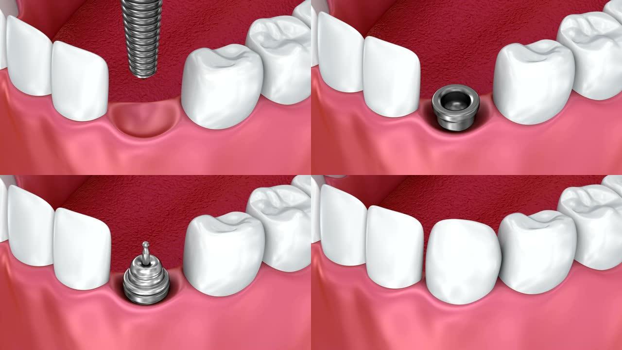 牙齿种植体安装过程，医学上精确的3d动画
