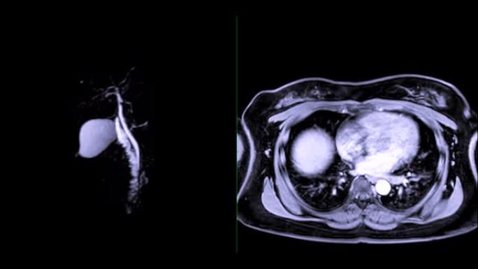 磁共振胰胆管造影或MRCP 3D MIP图像比较GD后的轴向T1W以可视化胆管和胰管。