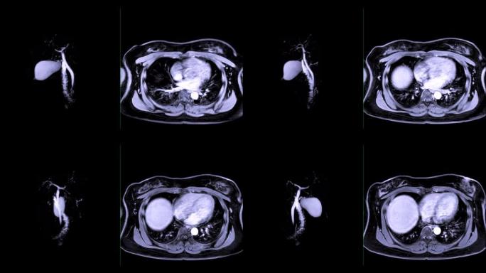磁共振胰胆管造影或MRCP 3D MIP图像比较GD后的轴向T1W以可视化胆管和胰管。