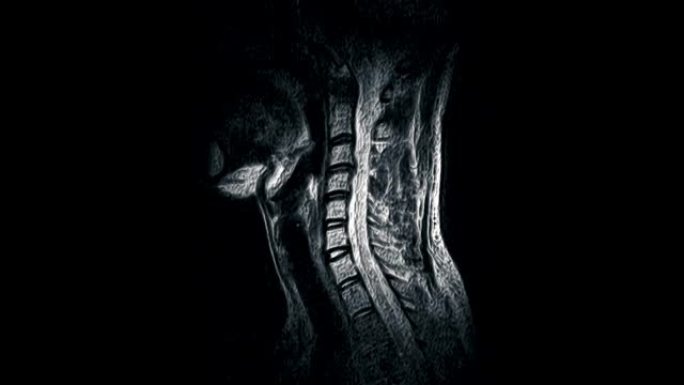 颈椎体积MRI，检测突起和疝气