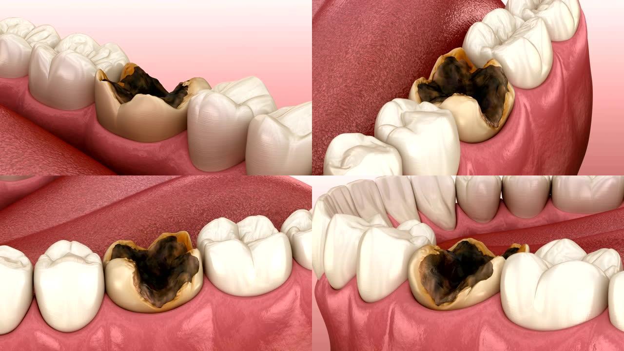 龋齿损坏的臼齿。医学上精确的牙齿3D动画。