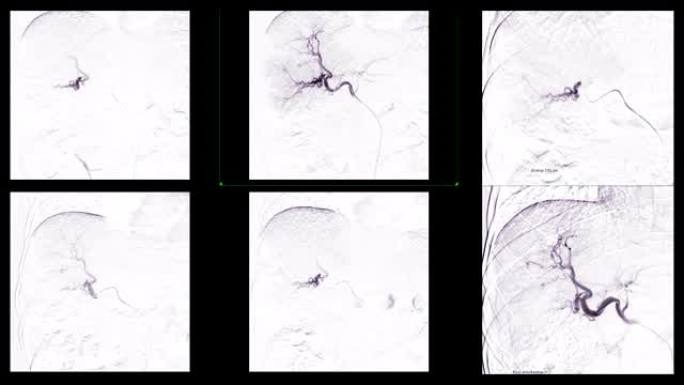 TOCE或经导管油性化疗栓塞的多视图是一种允许将一定剂量的化疗药物直接施用于肿瘤的程序。