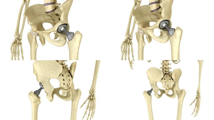 髋关节置换植入物安装在骨盆骨。医学上精确的3D动画