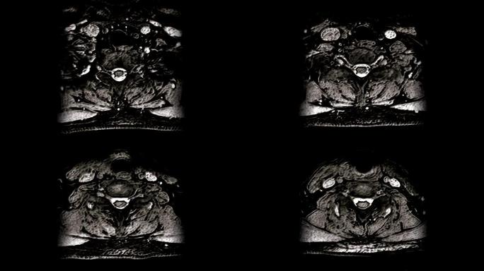 颈椎体积MRI，检测突起和疝气