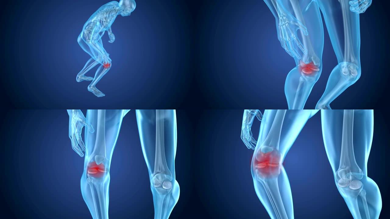 膝盖疼痛发作，男子患脊椎膝盖。3D动画