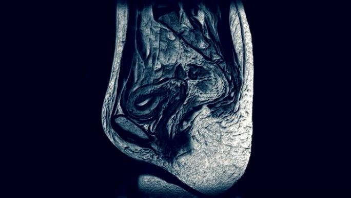 腹腔，胃肠道，膀胱的体积对比MRI