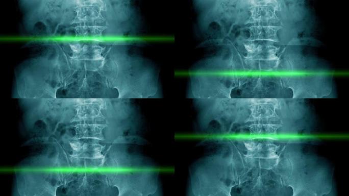 腰椎病或脊柱退行性改变