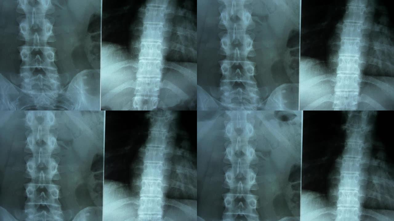 临床医生检查患者脊柱和胸部POV的x射线图像