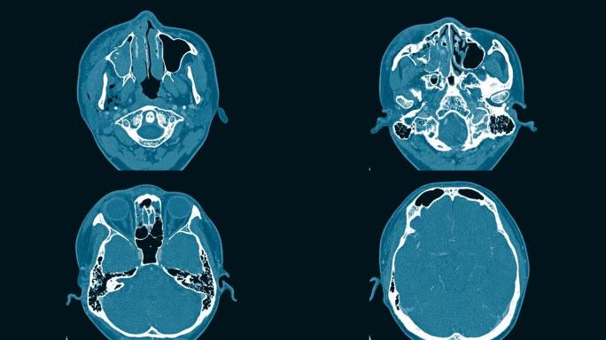 Ct扫描脑和眼眶