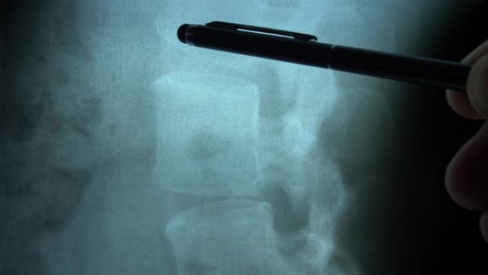 临床医生讨论使用钢笔指针对患者脊柱和胸部的x射线图像