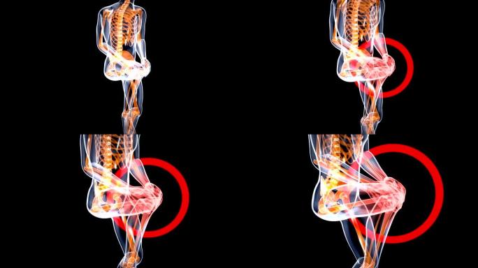 膝盖扭伤或疼痛导致疼痛运动设计