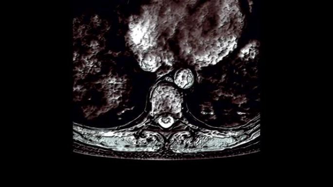 胸部区域的MRI，脊柱上的突起和疝气的检测