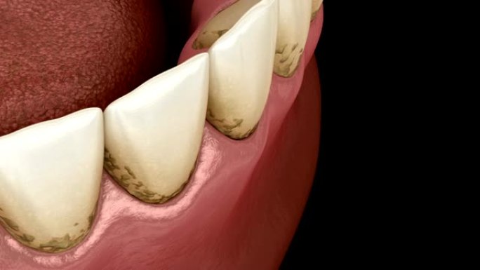牙垢和芽孢菌斑，下颌。人体牙齿治疗的医学精确3D动画