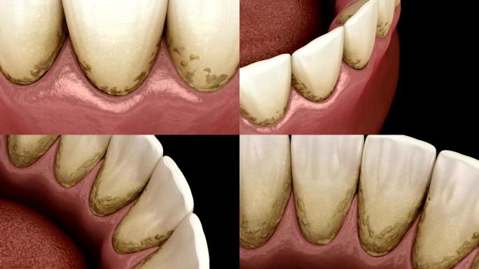 牙垢和芽孢菌斑，下颌。人体牙齿治疗的医学精确3D动画