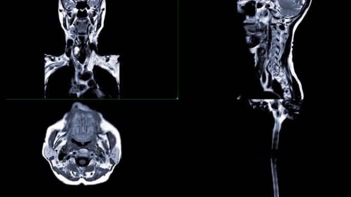 颈椎冠状位、矢状位、轴位和矢状位MRI脊髓图诊断脊髓压迫。