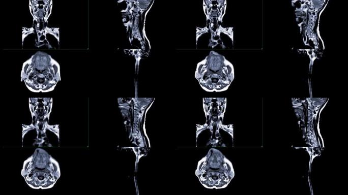 颈椎冠状位、矢状位、轴位和矢状位MRI脊髓图诊断脊髓压迫。