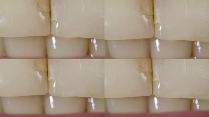 牙齿治疗中需要牙垢和牙齿填充物的前牙