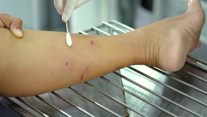 由于狗咬伤了腿，护士在患者的伤口上使用了带有防腐剂溶液的棉花蕾。
