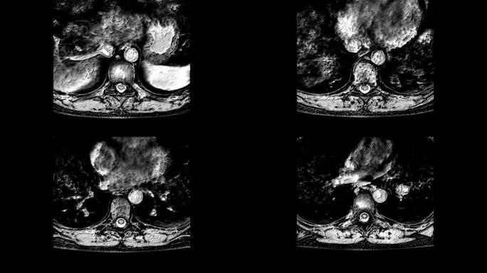 胸部区域的MRI，脊柱上的突起和疝气的检测