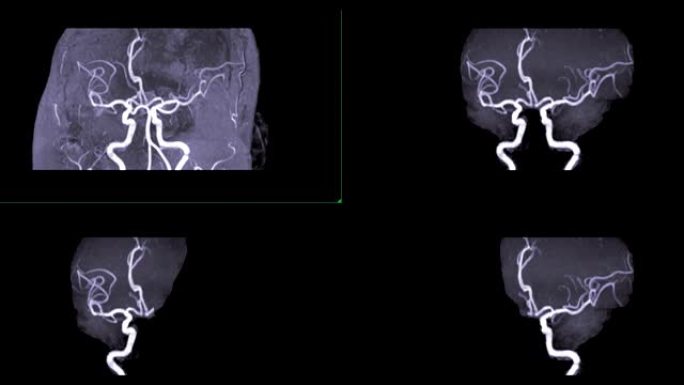 大脑中的血管MRA或磁共振血管造影 (MRA) 在屏幕上转动。MRA脑MIP视图用于评估脑动脉。