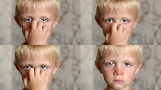 脸部和鼻子晒伤的儿童脸部特写。晒太阳。