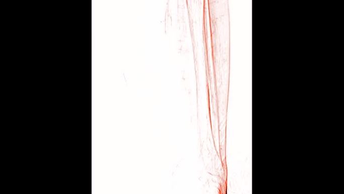 左股动脉周围血管造影显示白色背景上孤立的血管用于诊断动脉粥样硬化。