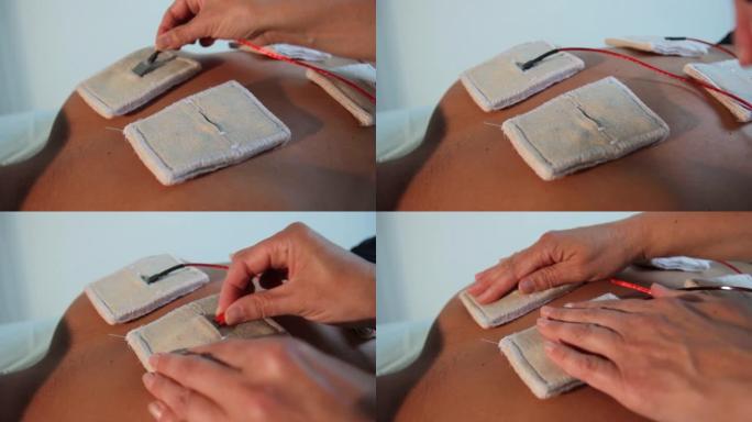 反射治疗师将电极固定在患者的背部进行电刺激。特写