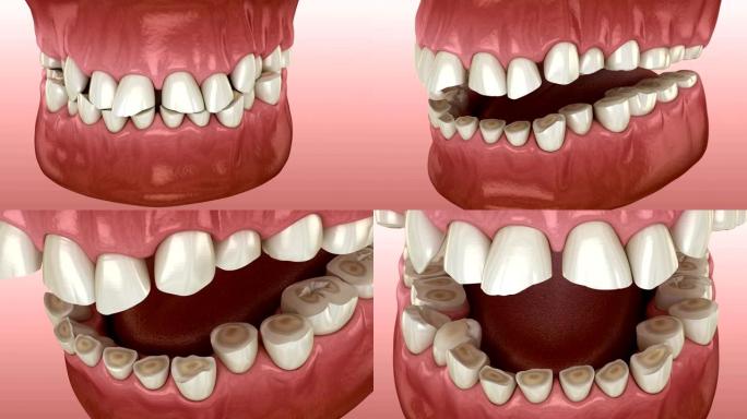 牙齿磨损 (磨牙症) 导致牙齿组织丢失。医学上精确的牙齿3D动画