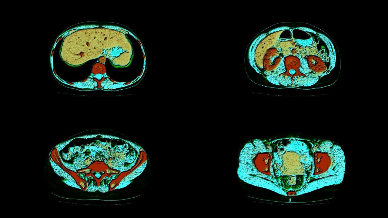 腹腔、胃肠道、膀胱的彩色对比MRI