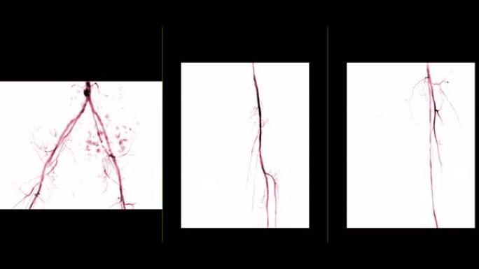 左股动脉血管造影的多视图显示白色背景上孤立的血管，用于诊断动脉粥样硬化。