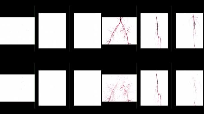左股动脉血管造影的多视图显示白色背景上孤立的血管，用于诊断动脉粥样硬化。