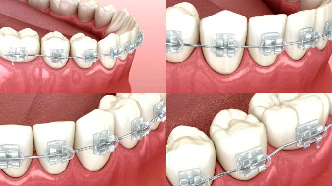 下颌颌和清晰的牙套。医学上精确的牙科3D动画