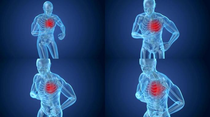 心脏病发作，患有心脏疼痛的人。3D动画